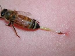  arı sokması ve tedavisi